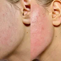 الکترولیز موهای زائد صورت