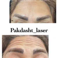 تزریق بوتاکس مصپورت ، کامل صورت توسط پزشک