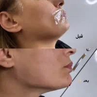آفر ویژه ژل و بوتاکس مدت محدود
