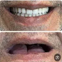 دندان مصنوعی ارزان قیمت