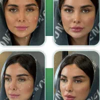 تخفیف ویژه بوتاکس صورت