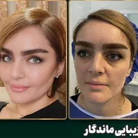 تزریق چربی بوکال فت کاشت مو ساکشن غبغب بلفاروپلاسی|خدمات آرایشگری و زیبایی|اصفهان, ملک‌شهر|دیوار