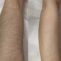 مرکز لیزر با بهترین دستگاه روز دنیا|خدمات آرایشگری و زیبایی|ایذه, |دیوار