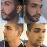 کاشت مو تیم شیراز و مشهد در یزد (تضمینی و اقساطی)|خدمات آرایشگری و زیبایی|یزد, |دیوار