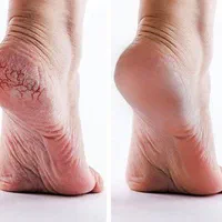 پارافین تراپی/رفع خشکی و تیرگی/لایه های شاخی/پوست|خدمات آرایشگری و زیبایی|شیراز, نصر|دیوار