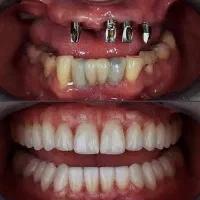 تخفیف وام دندانپزشکی ایمپلنت کامپوزیت روکش عصب کشی