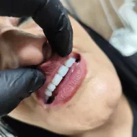 دندان مصنوعی طرح کامپوزیت و لمینت هر فک ۵ تومان|خدمات آرایشگری و زیبایی|کرج, کمالشهر|دیوار