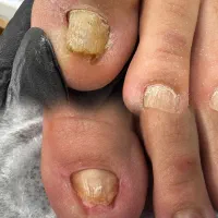 پذیرش محدود کیس‌های درمانی ناخن