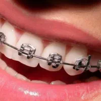 ارتودنسی توسط متخصص به صورت اقساط بدون پیش پرداخت