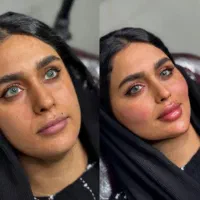 تزریق ژل بوتاکس واموزش فقط ۸تومن فقط تا ۱اسفند