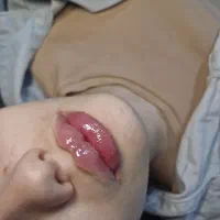 آف تزریق بوتاکس وژل روسی بدون گوله‌شدن/MD/فیلربادی