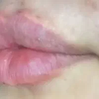 تزریق ژل و بوتاکس