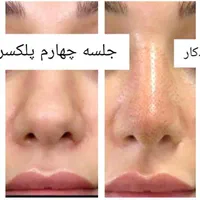 کوچک کردن بینی ورفع پف چشم بدون عمل جراحی|خدمات آرایشگری و زیبایی|مشهد, کوثر|دیوار