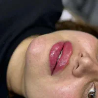 ژل فولفیس + بوتاکس رایگان / زیر نظر پزشک