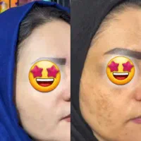قویی ترین ضدلک جهانی