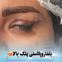 بلفاروپلاستی پلک توسط جراح