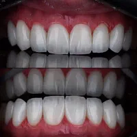 کامپوزیت.لمینت|خدمات آرایشگری و زیبایی|تهران, هفت حوض|دیوار