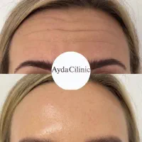 تخفیف بوتاکس و ژل|خدمات آرایشگری و زیبایی|دهگلان, |دیوار