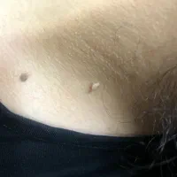 حذف انواع خال (گوشتی،سطحی،زیگیل)