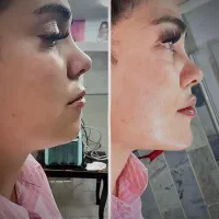 جشنواره فیلرو بوتاکس با قیمت باور نکردنی در مطب|خدمات آرایشگری و زیبایی|کرج, گوهردشت|دیوار