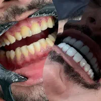 کامپوزیت دندان با برندهای معتبر جهانی|خدمات آرایشگری و زیبایی|اهواز, نادری|دیوار