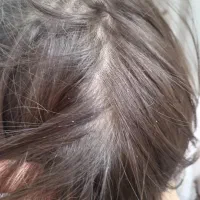 پاکسازی شپش ورشک|خدمات آرایشگری و زیبایی|سبزوار, شرق کال میانی|دیوار