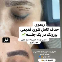 ریموو،پاک کردن تتوی صورت