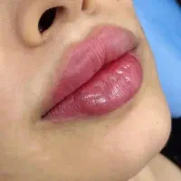 خدمات تخصصی بوتاکس و فیلر