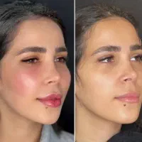 تزریق ژل سی سی ۵۰۰