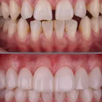 دندانپزشکی ارزان کف قیمت درمانی زیبایی افسریه