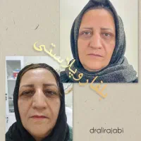 بوتاکس ژل فیلر چربی بلفاروپلاستی مزو PRP نخ لیزر|خدمات آرایشگری و زیبایی|شاهین‌شهر, فردوسی|دیوار