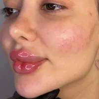 ژل و بوتاکس|خدمات آرایشگری و زیبایی|شیراز, شهرک مهدی‌آباد|دیوار