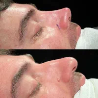 عمل/بینی/ جراحی زیبایی/بدون تامپون/اقساطی|خدمات آرایشگری و زیبایی|کرج, عظیمیه|دیوار