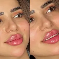 ژل لب روسی بوتاکس هیرفیلر کانتورینگ لیفت صورت|خدمات آرایشگری و زیبایی|تهران, دریا|دیوار