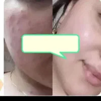 کرم ویتامینه وآبرسان قوی ضدلک وکک ومک معجزه|آرایشی، بهداشتی، درمانی|اهواز, دغاغله|دیوار