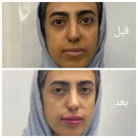 تزریق انواع بوتاکس ،ژل،مزوتراپی ،نخ.انزیم|خدمات آرایشگری و زیبایی|مشهد, سرافرازان|دیوار