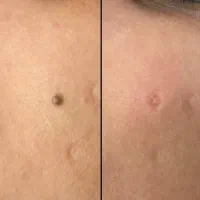 برداشت خال ،زیگیل،کک و مک،پاک کردن تتو در کیلینیک|خدمات آرایشگری و زیبایی|کرمانشاه, |دیوار