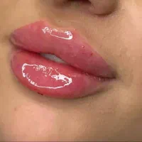 ژل و بوتاکس مزوژل مزو تخفیف ویژه تا پایان شهریور|خدمات آرایشگری و زیبایی|مشهد, فلسطین|دیوار