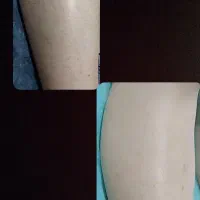 جشنواره تخفیف لیزر موهای زائد تضمینی تحت نظر پزشک|خدمات آرایشگری و زیبایی|خرم‌آباد, |دیوار