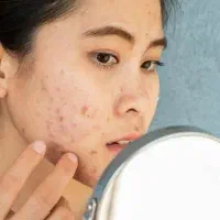 درمان جوش صورت و لک وریشه مشکلات پوستی