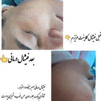 ارائه خدمات فیشال  و پاکسازی صورت با بهترین متریال|خدمات آرایشگری و زیبایی|مشهد, عبادی|دیوار