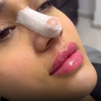 تزریق لب روسی/فیلر بادی/بوتاکس/مزوژل/prp|خدمات آرایشگری و زیبایی|تهران, تهرانپارس غربی|دیوار