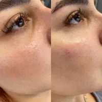 پاکسازی و فیشال پوست|خدمات آرایشگری و زیبایی|تهران, سلسبیل شمالی|دیوار