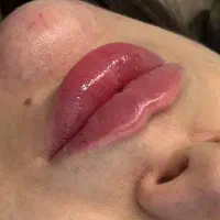فیلر لب و صورت (باهم) فقط ۱۰ میلیون