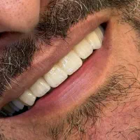 ایمپلنت یکروزه فقط با16تومان (بیمه واقساط)|خدمات زیبایی و سلامت|تهران, دردشت|دیوار
