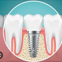 ایمپلنت کره ای فقط۶/۵۰۰ میلیون