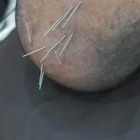 مطب پزشکی.طب سوزنی و طب سنتی