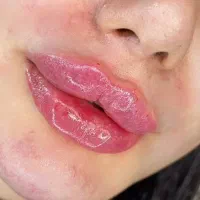 جشنواره تزریق ژل و بوتاکس در مطب با۴۰درصد تخفیف|خدمات آرایشگری و زیبایی|کرمانشاه, |دیوار