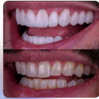 *جشنواره یلدا ترمیمی زیبایی ایمپلنت در کلینیک نیک*