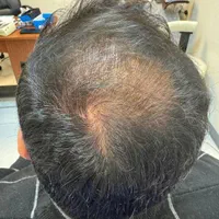 پی ار پی مو،صورت،اگزوزوم،مزوتراپی،هیرفیلر PRP|خدمات آرایشگری و زیبایی|تهران, هفت حوض|دیوار